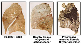 Pictures of healthy and diseased lung tissue